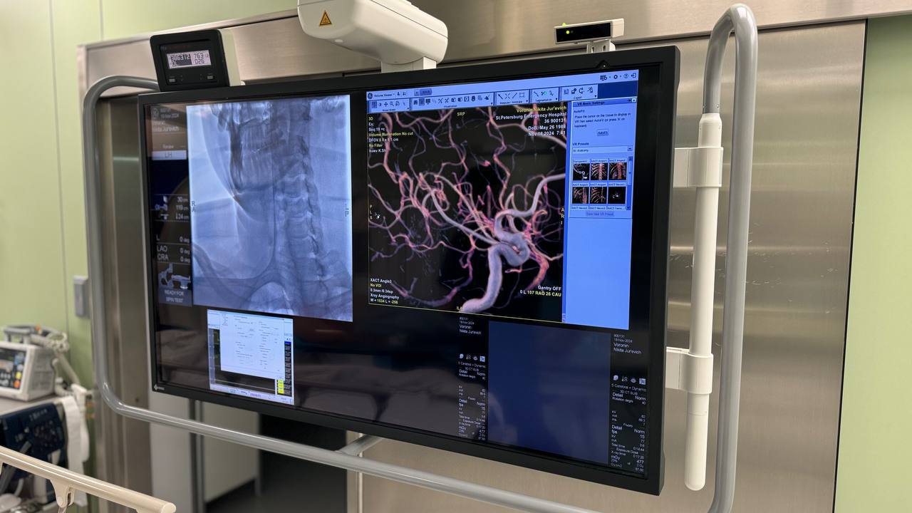 Новейшие технологии позволяют оперировать аневризмы головного мозга, госпитализируя пациента всего на 2 дня