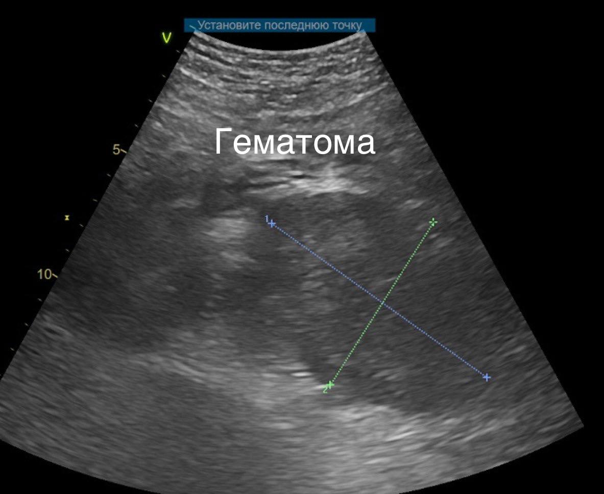 «Сохранить, а не удалить»: применение новой тактики лечения тяжелых травм почки в экстренной медицине