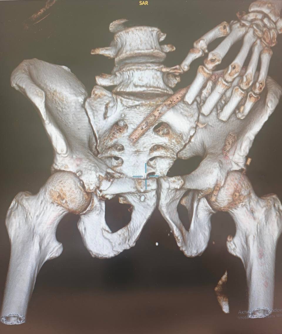 Врачи НИИ спасли мужчину с 50 баллами по шкале оценки тяжести травм (ISS)