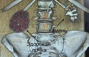 Врачи НИИ скорой помощи имени Джанелидзе удалили пациентке почку, «разрушенную» гигантским «кораллом»