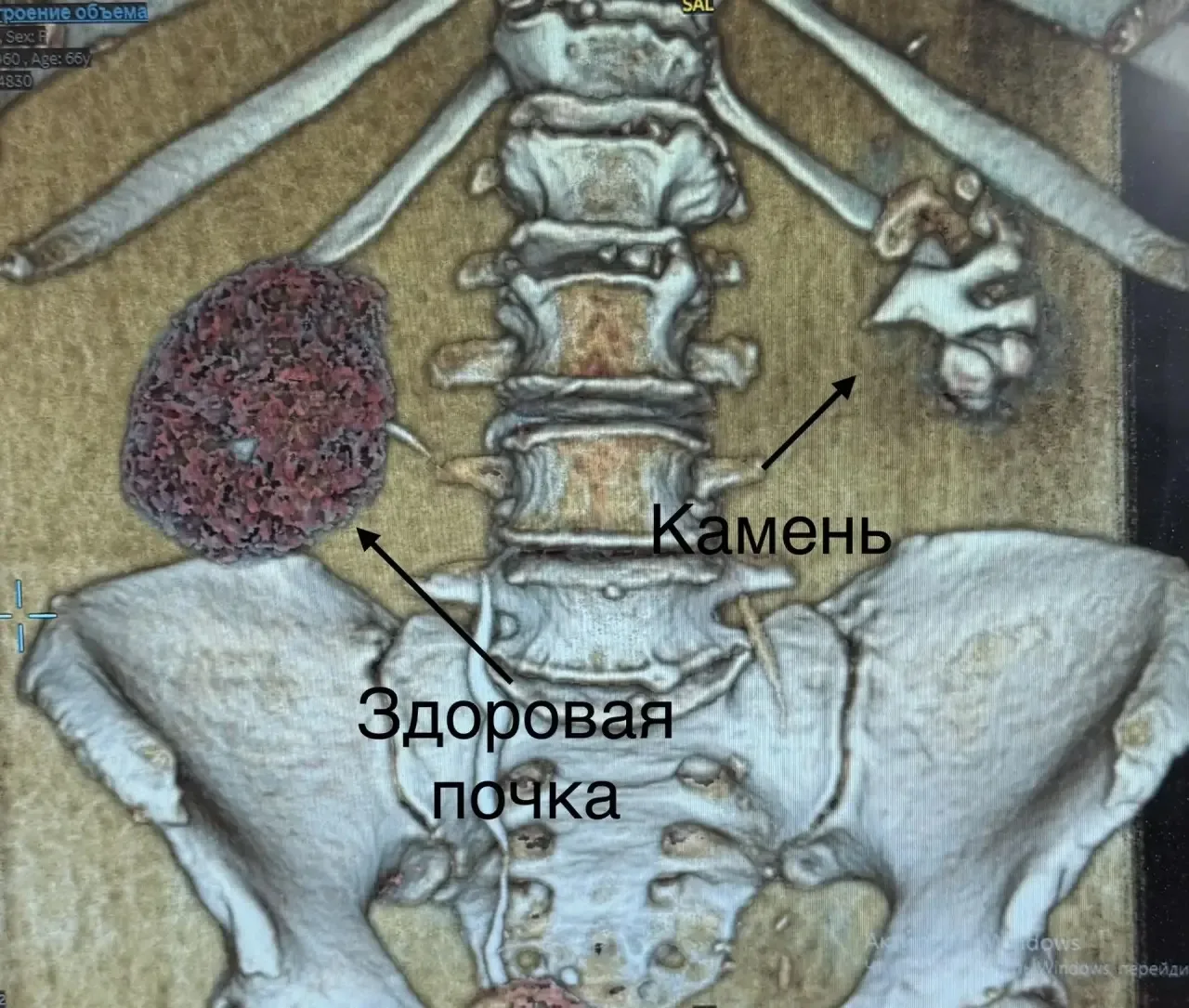 Врачи НИИ скорой помощи имени Джанелидзе удалили пациентке почку, «разрушенную» гигантским «кораллом»